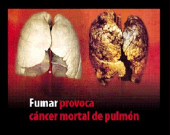 Spain 2011 Health Effects lung - diseased organ, lung cancer, gross